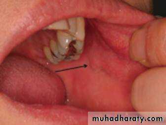 Salivary gland ppt