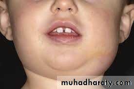 Salivary gland ppt