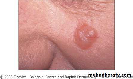 Skin Tumors