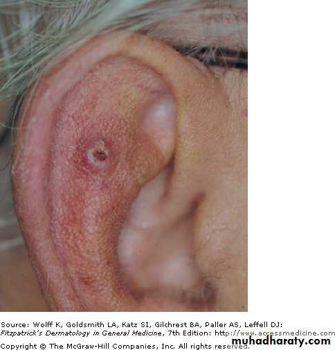 Skin Tumors