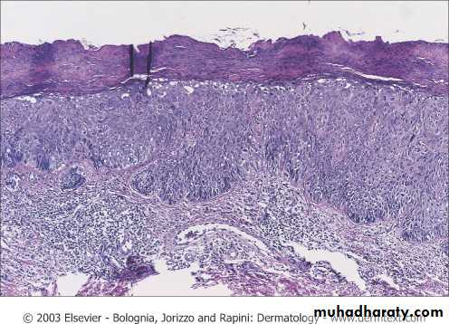 Skin Tumors
