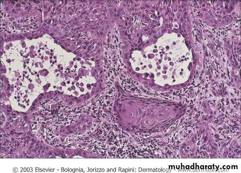 Skin Tumors