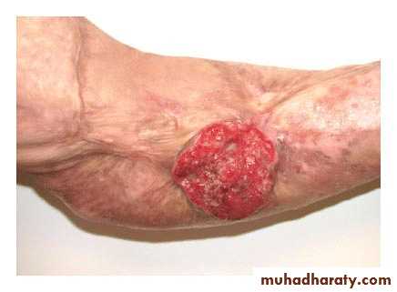 Skin Tumors