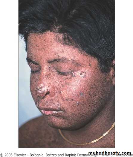 Skin Tumors