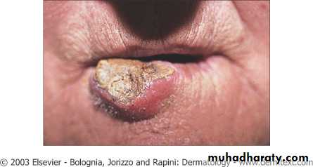 Skin Tumors