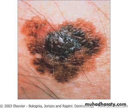 Skin Tumors