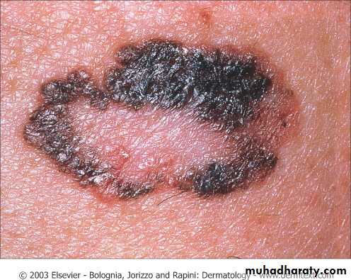 Skin Tumors
