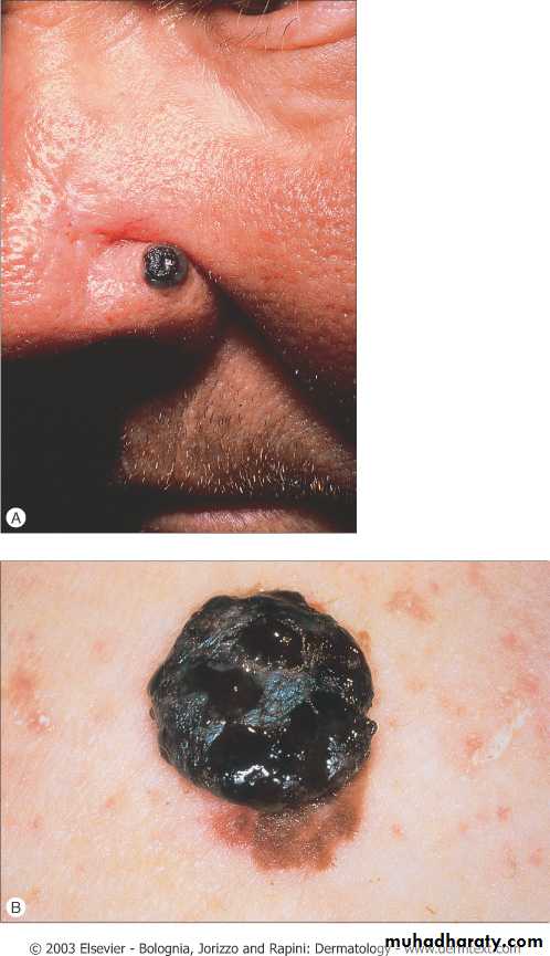 Skin Tumors