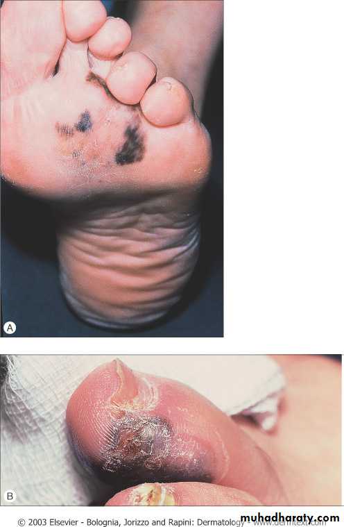 Skin Tumors