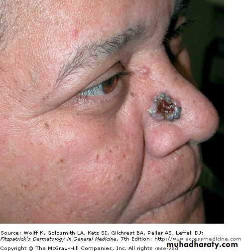 Skin Tumors