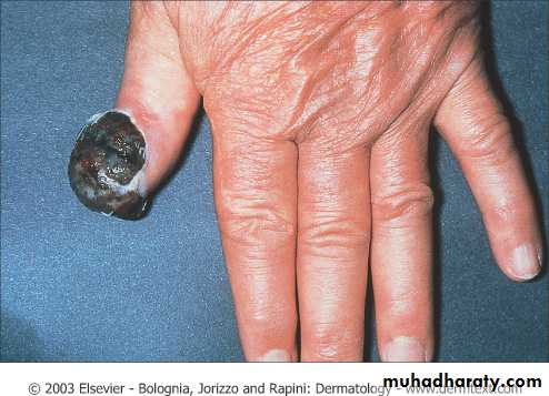 Skin Tumors