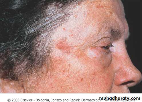 Skin Tumors