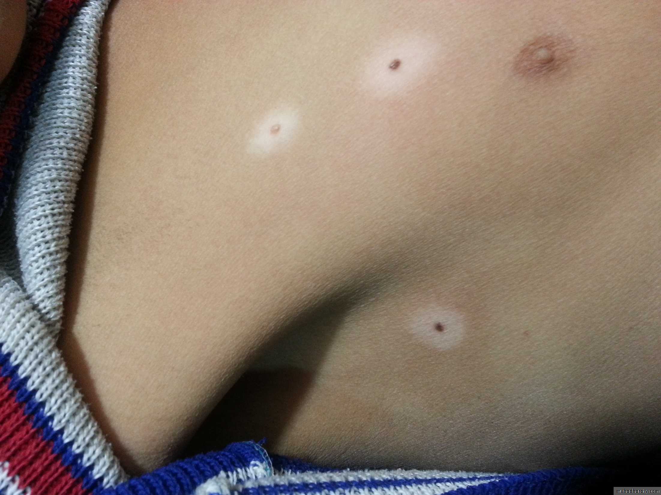 Skin Tumors