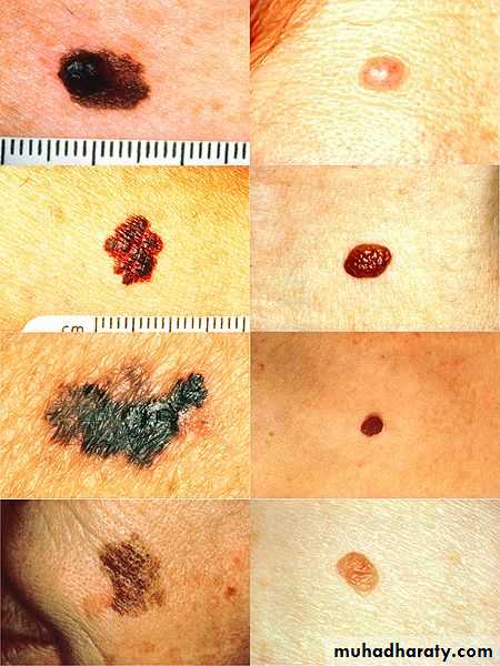 Skin Tumors