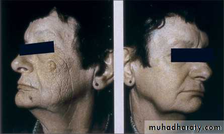 Skin Tumors