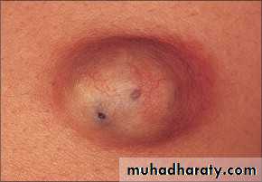 Skin Tumors