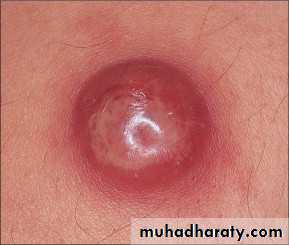 Skin Tumors