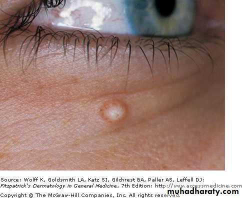 Skin Tumors