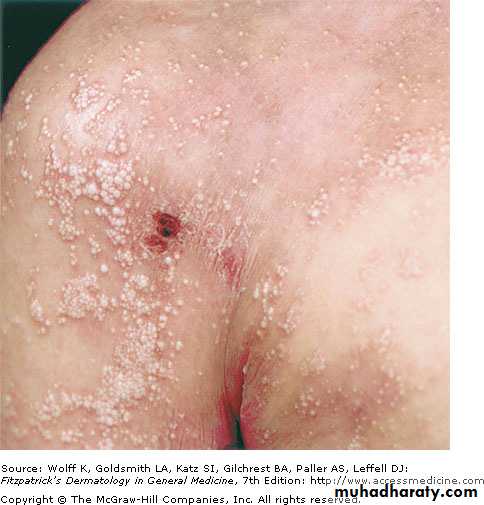 Skin Tumors