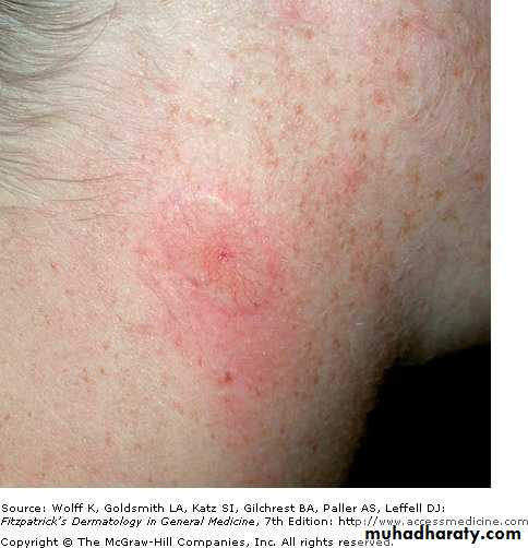 Skin Tumors