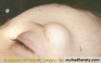 Skin Tumors