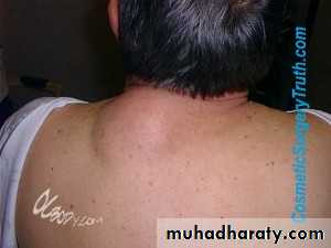 Skin Tumors