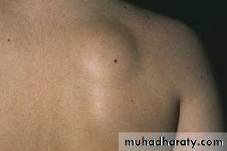 Skin Tumors