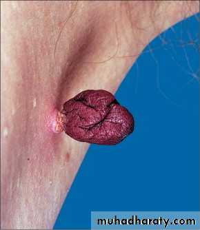 Skin Tumors