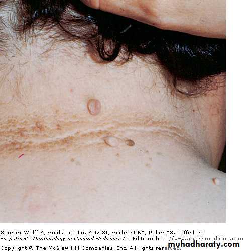 Skin Tumors
