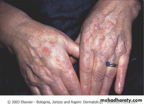 Skin Tumors