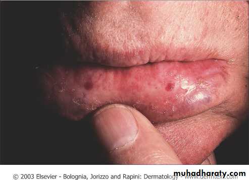Skin Tumors