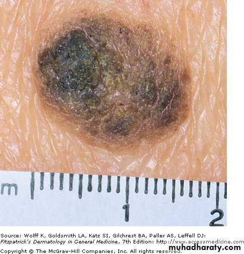 Skin Tumors