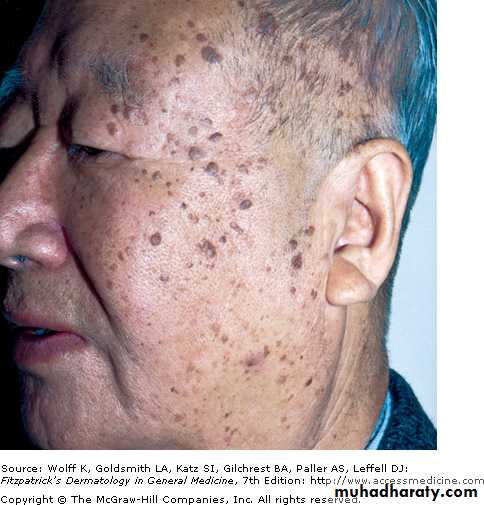 Skin Tumors