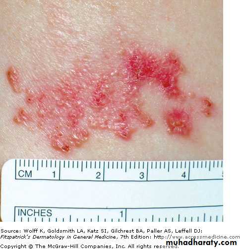Skin Tumors