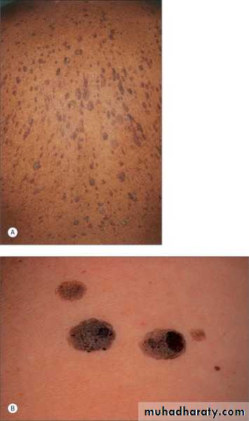 Skin Tumors