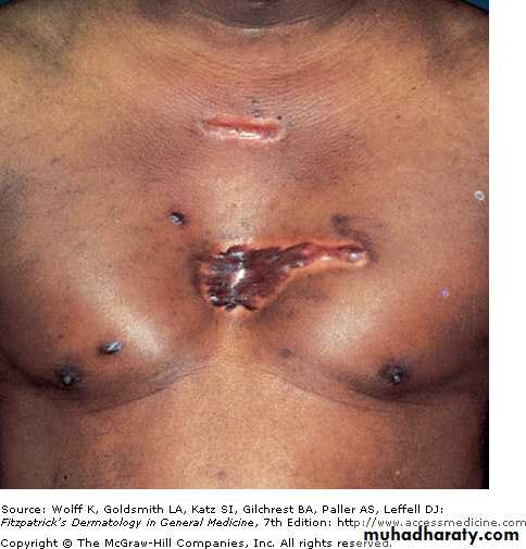 Skin Tumors