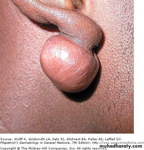 Skin Tumors