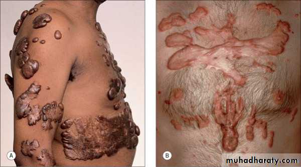 Skin Tumors