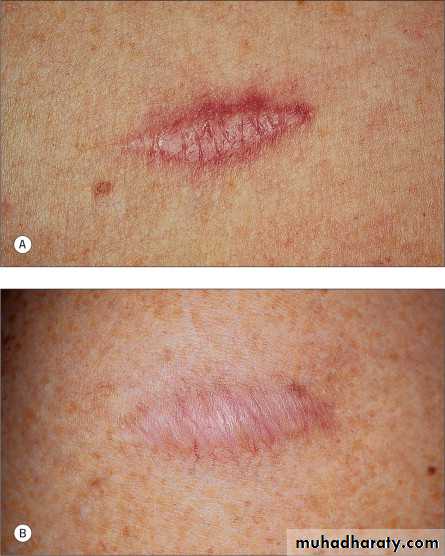 Skin Tumors