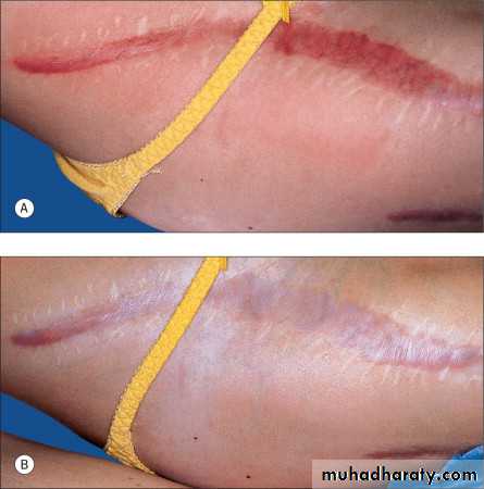 Skin Tumors