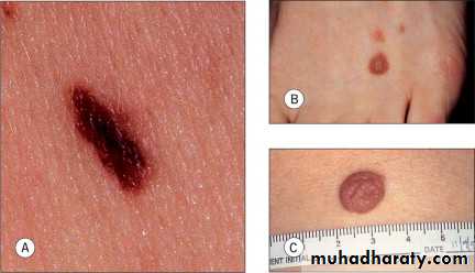 Skin Tumors