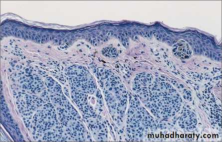 Skin Tumors