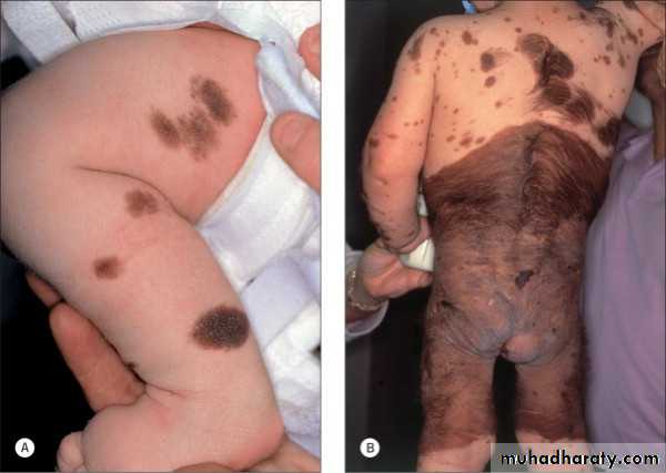 Skin Tumors