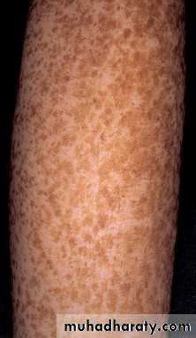 Skin Tumors
