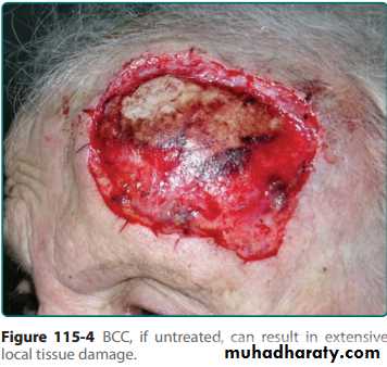 Skin Tumors