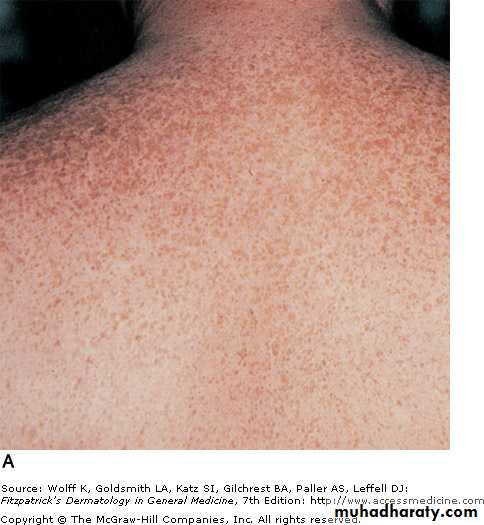 Skin Tumors