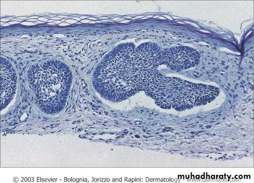 Skin Tumors