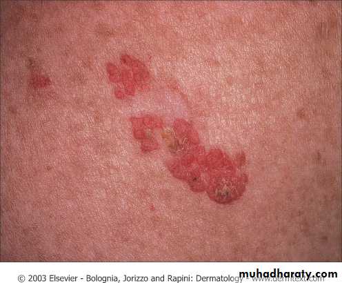 Skin Tumors