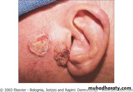 Skin Tumors