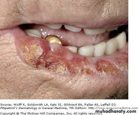 Skin Tumors